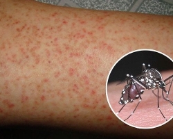 Những điều cần biết về bệnh Sốt xuất huyết các biện pháp phòng bệnh